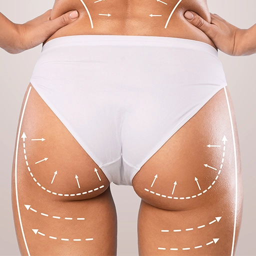 Butt Lift